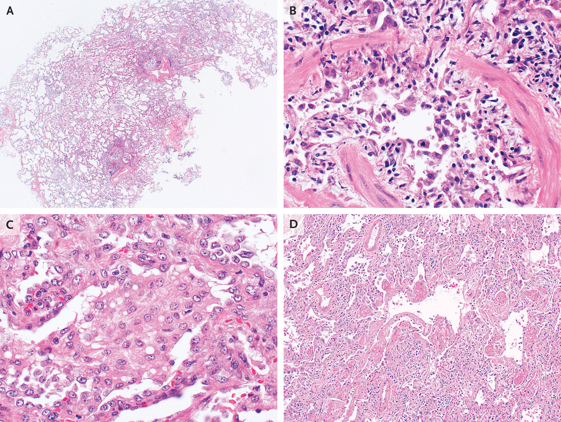 Histopatología de la lesión pulmonar aguda asociada con el vapeo 2019