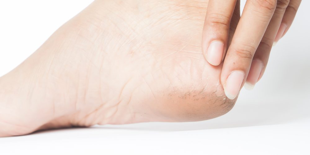 Tratamiento para pies resecos